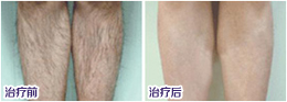 昆明脱毛医院哪家专业？