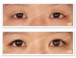 双眼皮手术有哪些优势?