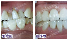 隐形矫牙，让美丽不再“铁齿铜牙”