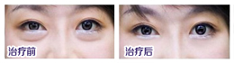 如何去眼袋？