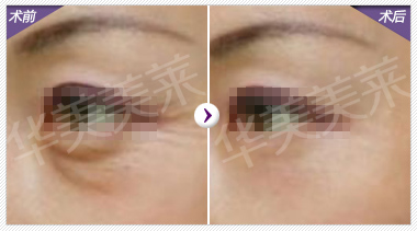 网友提问：鱼尾纹可以预防吗？