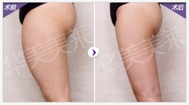 夏季就该秀美腿  大长腿打造方法