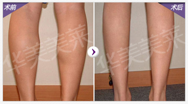 夏季就该秀美腿  大长腿打造方法