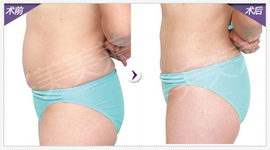 肚子吸脂术后皮肤会不会变松