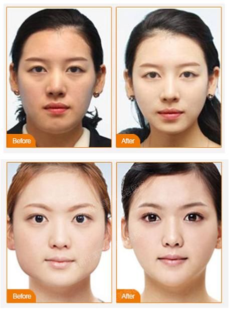 美莱韩式改脸型