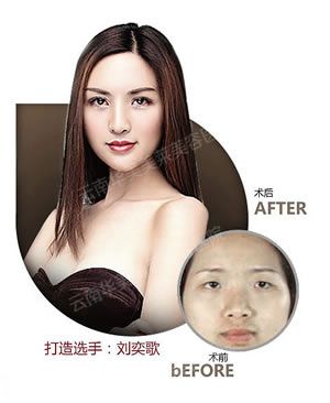 埋线双眼皮的线会断掉吗？