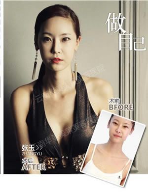 假体君脂肪君都说：丰胸去美莱