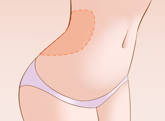 腰部吸脂减肥